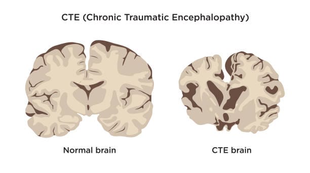 Chronic Traumatic Encephalopathy CTE before and after comparison of normal brain and CTE brain vector.